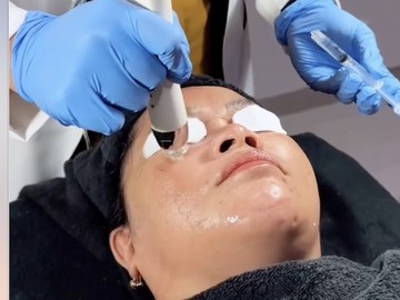 Mencoba Derma Boostox, Kombinasi Skin Booster &amp; Botox dengan Dermapen